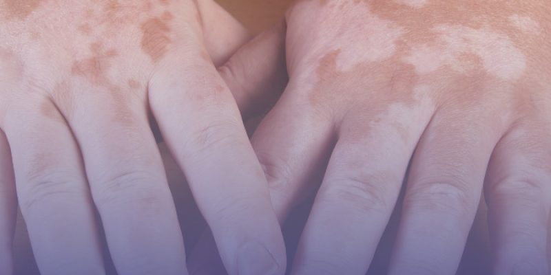 Demystifying Autoimmune Conditions